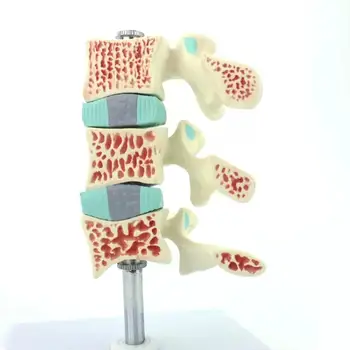 PVC Gyvenimo Dydžio Žmonių Osteoporozė, Stuburo Segmento Modelis Medicinos Mokymo Modeliai